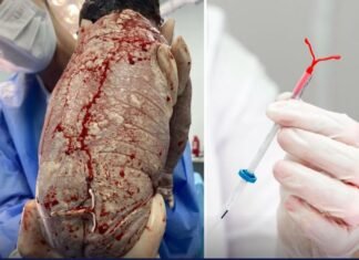 Foto de bebê com DIU colado ao corpo viraliza nas redes sociais