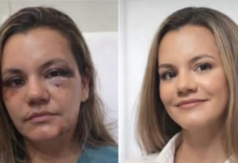 Após Agressão Brutal, Juliana Garcia Revela Resultados de Reconstrução Facial