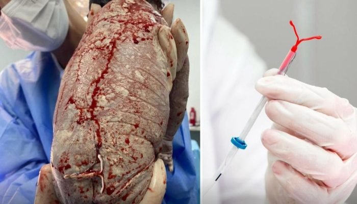 Foto de bebê com DIU colado ao corpo viraliza nas redes sociais
