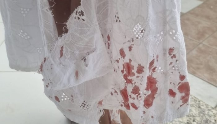 Uma mulher foi atacada por vários cães no bairro Atrás da Banca, em Petrolina, em um caso que ...