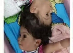 Gêmeas unidas pela cabeça falecem em cirurgia final de separação em SP