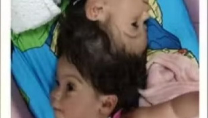 Gêmeas unidas pela cabeça falecem em cirurgia final de separação em SP