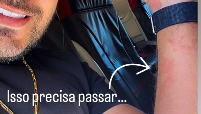 Ex-bbb Caio Afiune enfrenta crise alérgica durante voo e preocupa fãs